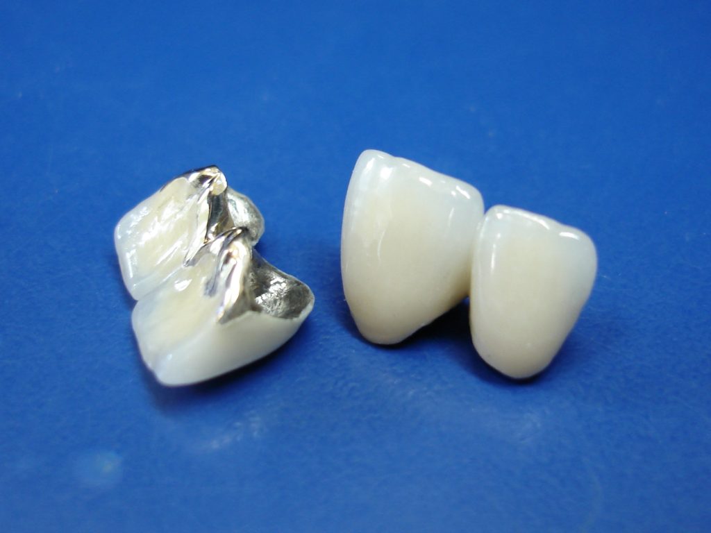 Зубные коронки металлокерамические