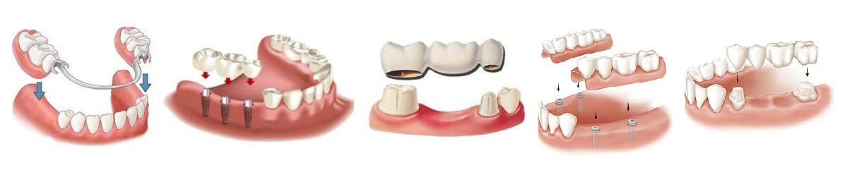 Условно съемное протезирование зубов