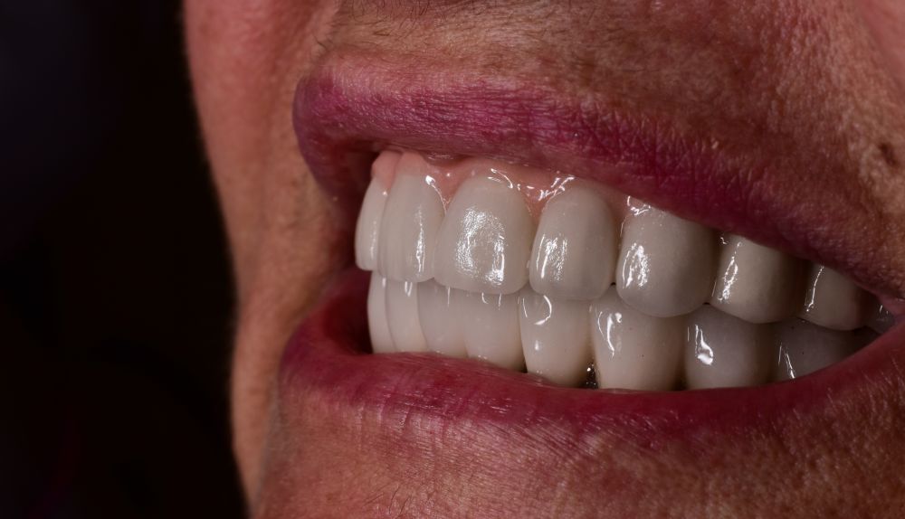 Пациенты после протезирвания зубов