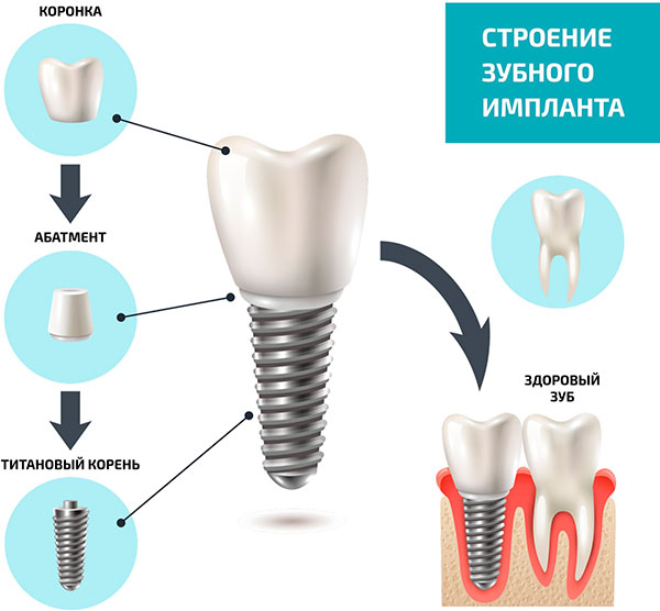 Имплант