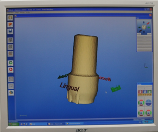 Трехмерная модель супраструктуры дентального имплантата в программе CEREC 3D V3.60