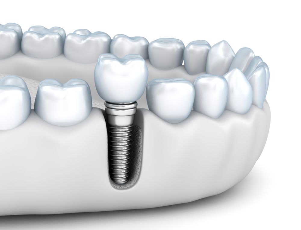 Стоимость имплантации одного зуба