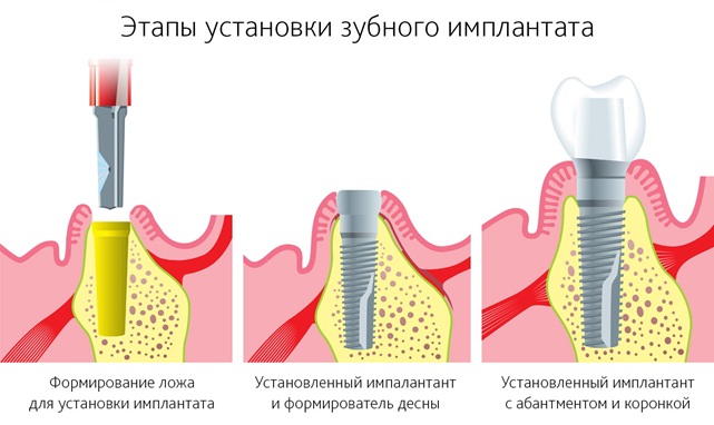 Протезирование зубов при отсутствии большого количества